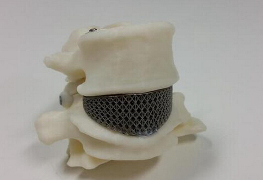 3D打印治疗脊椎病？澳大利亚首例植入手术成功1