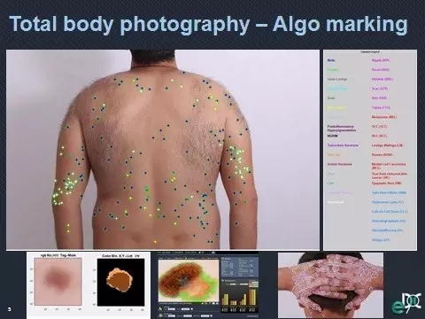 扎克伯格推荐了一款人工智能应用，可以比医生更好地诊断皮肤癌