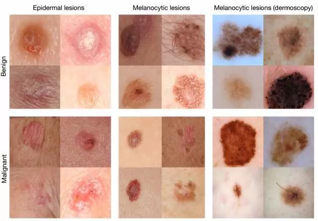 深度学习识别皮肤癌媲美医生，智能手机检测癌症