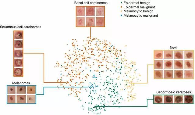 深度学习识别皮肤癌媲美医生，智能手机检测癌症