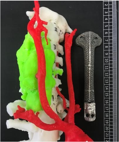 让椎体“再生”，我国成功植入全球首例全颈椎的3D打印人工颈椎椎
