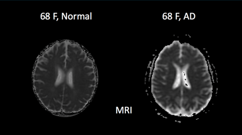 这款MRI分析软件，比现有技术早15年诊断出老年痴呆