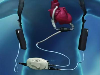这款“环抱”心脏的软体机器人，可让坏死的心脏重新跳动