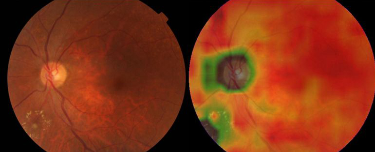 科学家用AI系统检测眼疾，比专业医生和验光师还强