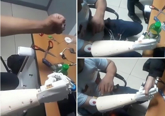 吉尔吉斯斯坦国立医院首次研发仿生义肢，可由大脑意念操控